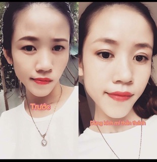 Kích mí lưới