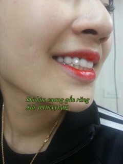 Đá, Kim cương nhân tạo gắn răng