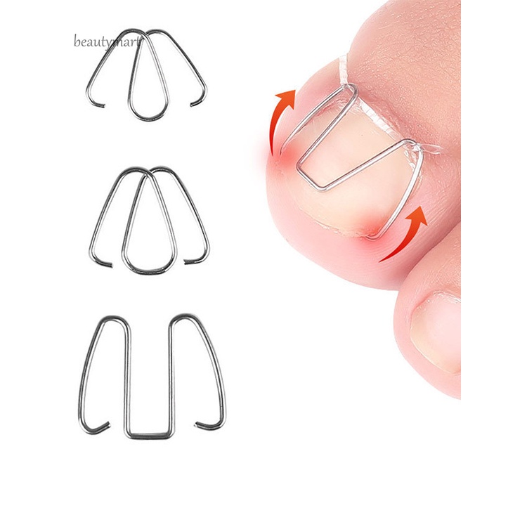 [Hàng mới về] Dụng cụ hỗ trợ điều chỉnh móng chân mọc ngược dễ dàng