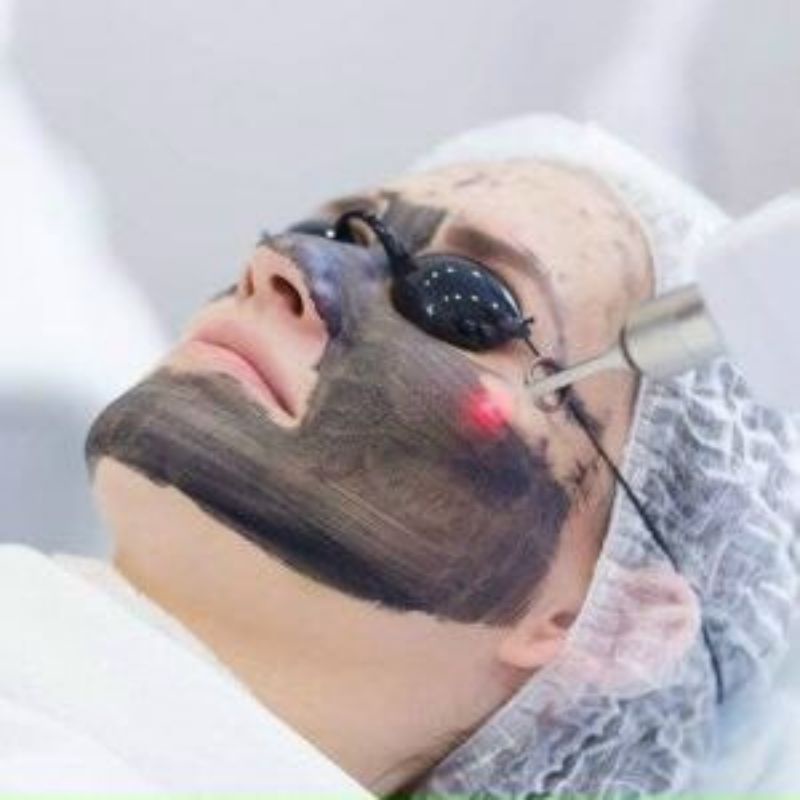 Than Carbon Bắn Laser - Than Laser Carbon Black Peel Hàn Quốc 57g