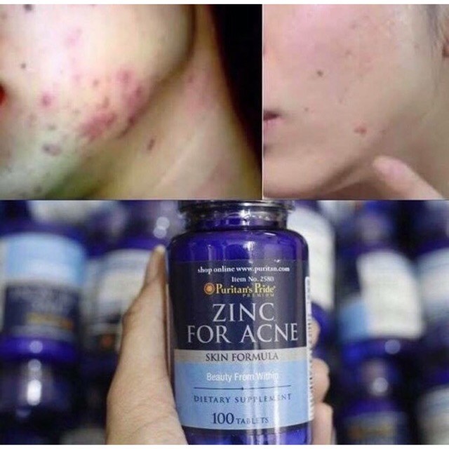 Viên Bổ Sung Kẽm Giảm Mụn ZINC FOR ACNE 100 Viên