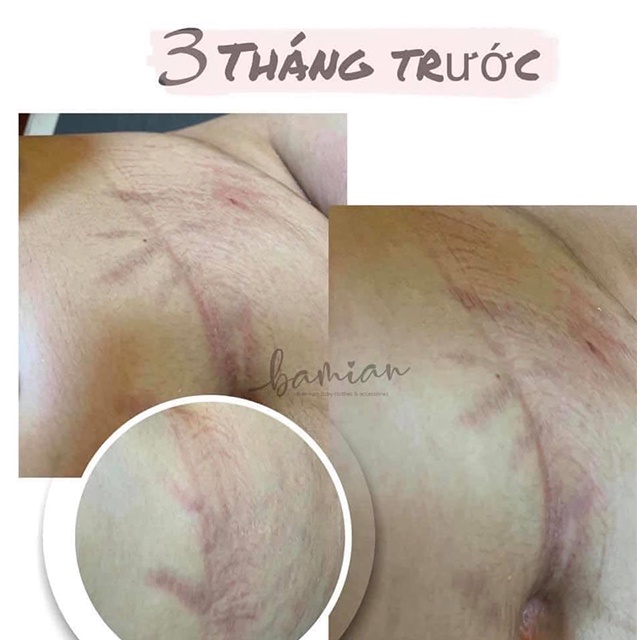 Kem bôi rạn STRETCHEAL mờ vết rạn sau sinh hiệu quả 180ml chính hãng Mỹ | BigBuy360 - bigbuy360.vn