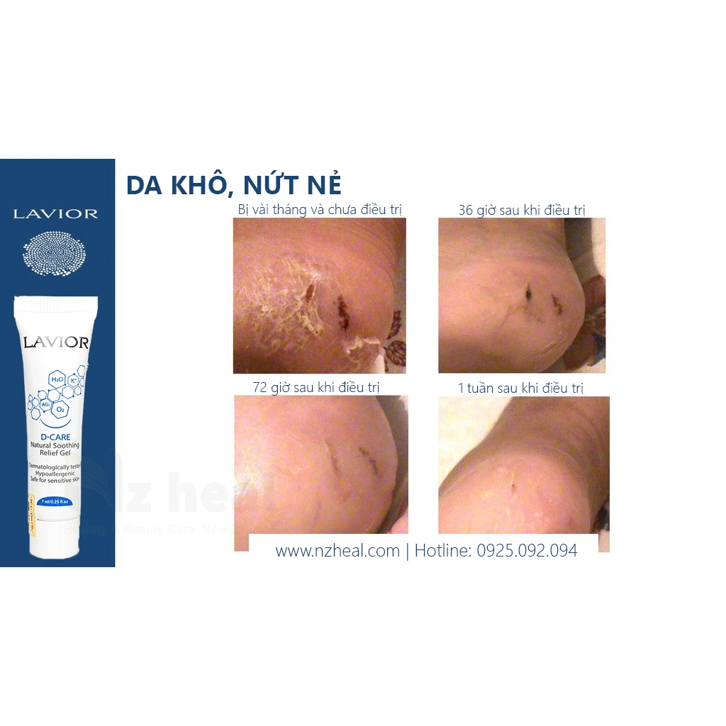 [Hỏa tốc] Lavior Diabetic Wound Gel 7ml - Làm lành vết thương, vết loét tì đè, loét chân tiểu đường, trầy xước da, bỏng