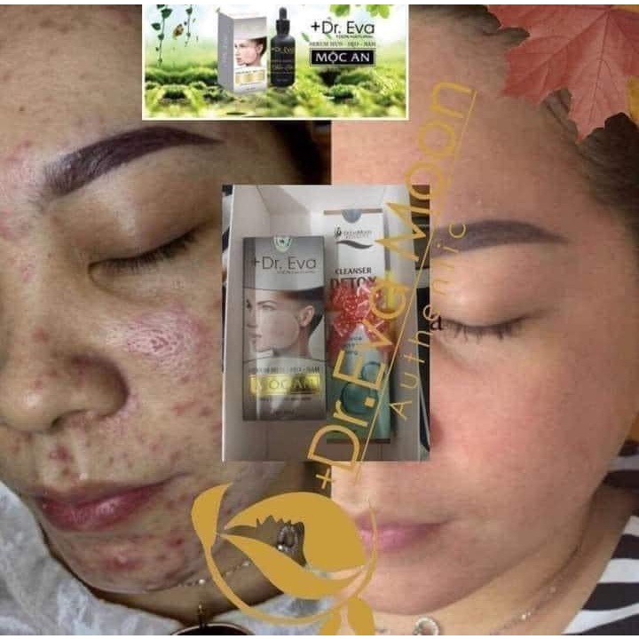 Kem Sẹo, Kem Sẹo Thâm, Rỗ Collagen Tươi Dr.EvaMoon