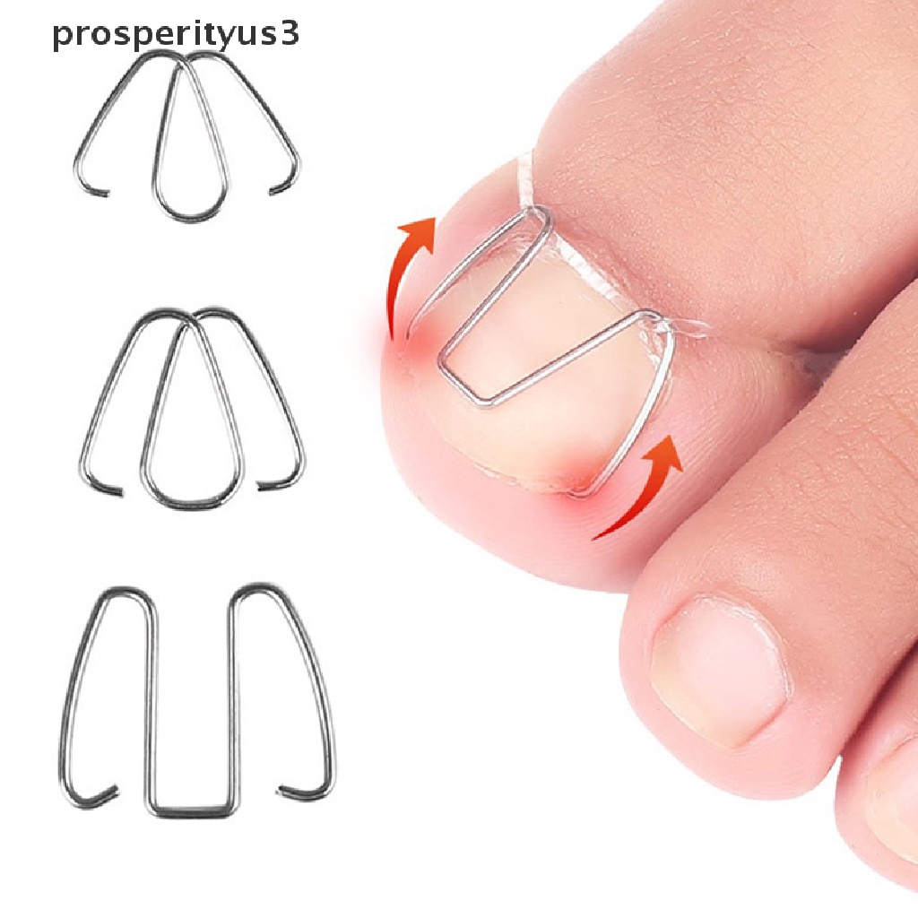 [prosperityus3] Nail Art Ingrown Toe Nail Correction Tool Toenail Nail Orthosis Paronychia Clip [new]