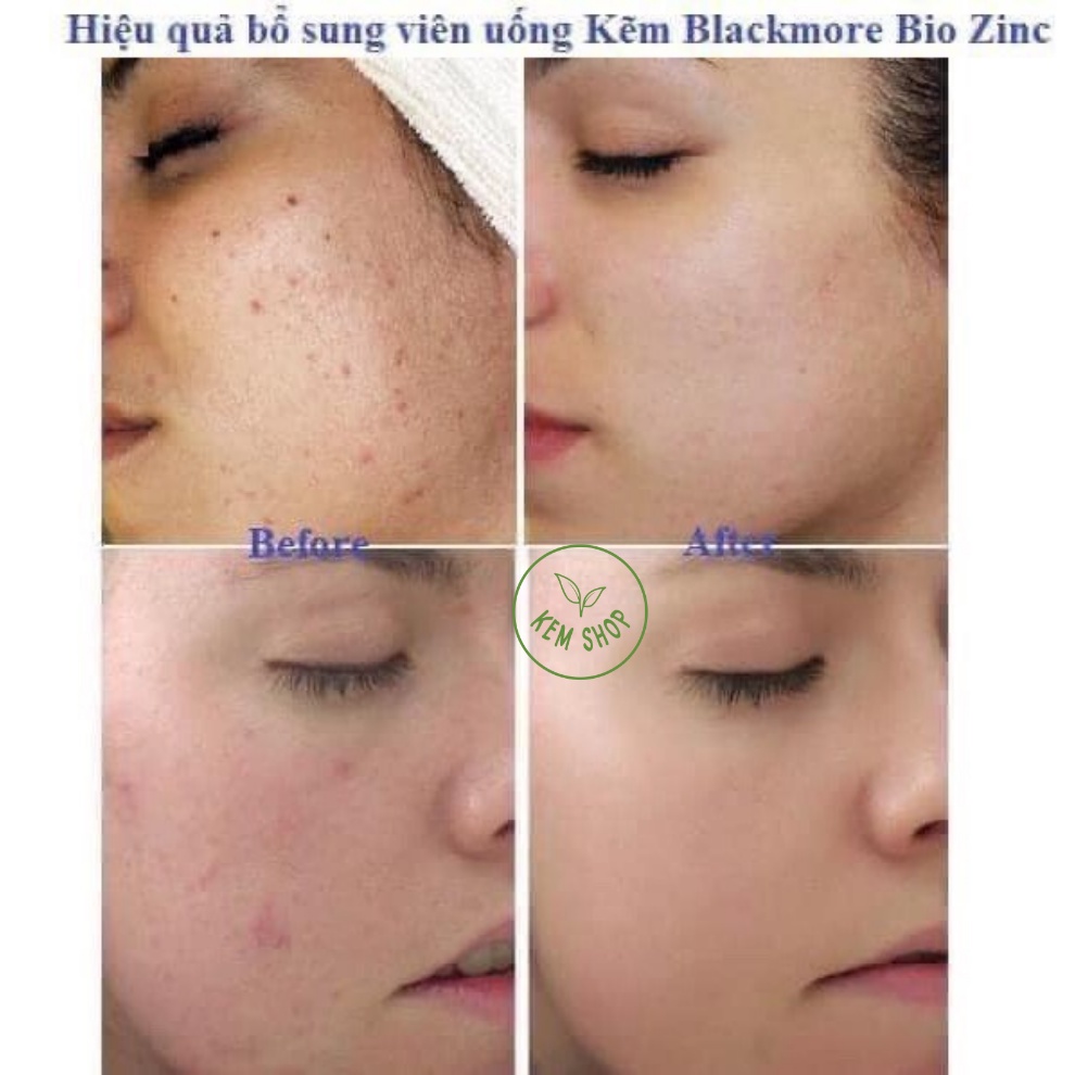 [Cam kết Chính hãng] Blackmores Bio Zinc - Viên uống bổ sung kẽm tự nhiên 84 viên Úc