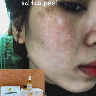 PEEL THAY DA MẶT TCA_USA