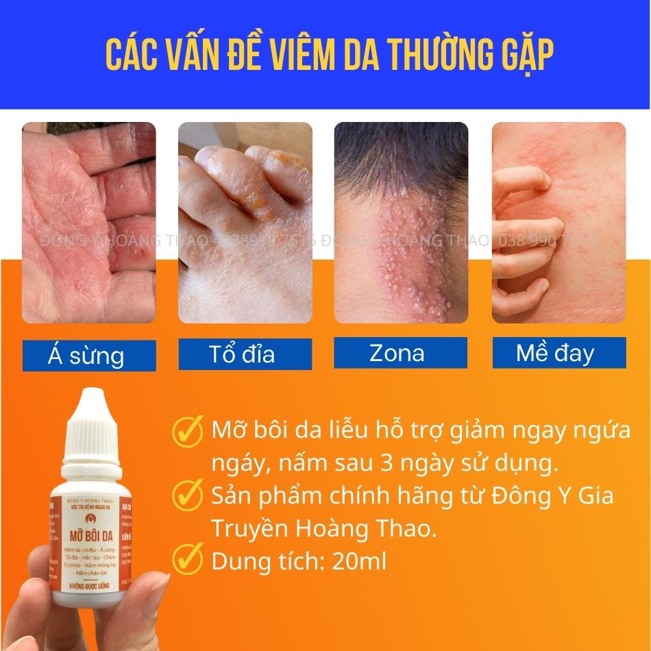 ✅ Mỡ Bôi Da Liễu hỗ trợ Ngứa da, Mề đay, Mẩn ngứa, Tổ đỉa, Á sừng, Eczema – Hoàng Thao