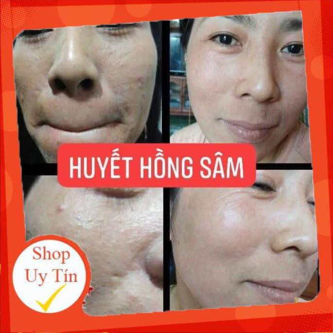 Đặc trị mụn Huyết Hồng Sâm - 100% từ thảo mộc thiên nhiên, giá rẻ - Đông Dược Vũ Đức | BigBuy360 - bigbuy360.vn