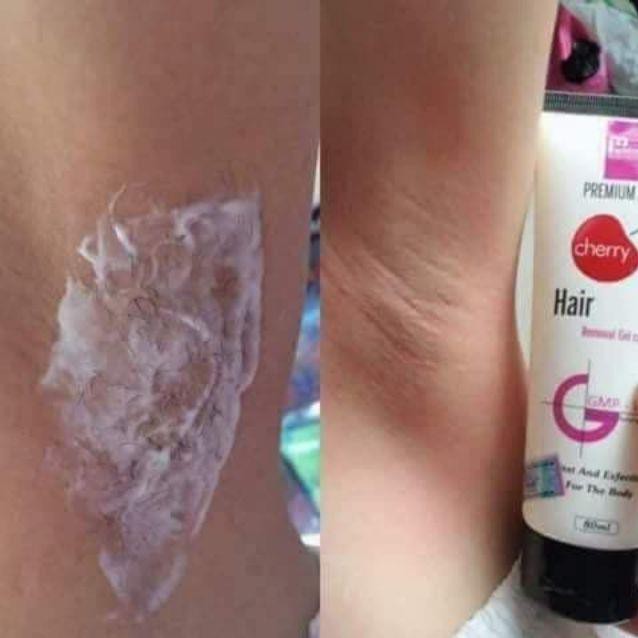 Triệt lông Mwhite | BigBuy360 - bigbuy360.vn