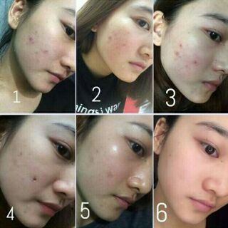 Kem bôi Shiseido Pimplit Nhật Bản 15g