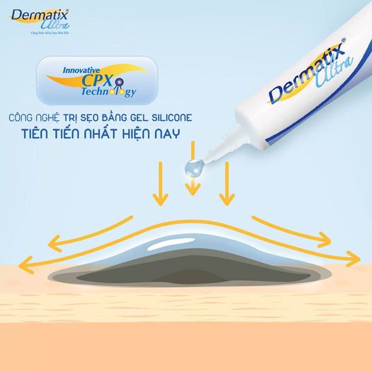 Dermatix Ultra - Gel Làm Mờ Sẹo Thâm, Sẹo Lồi, Cải Thiện Da