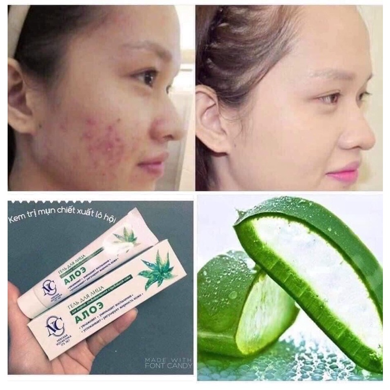 Gel Giảm mụn chiết xuất lô hội của Nga Giảm mụn đầu đen,mụn cám và làm mềm da 40g