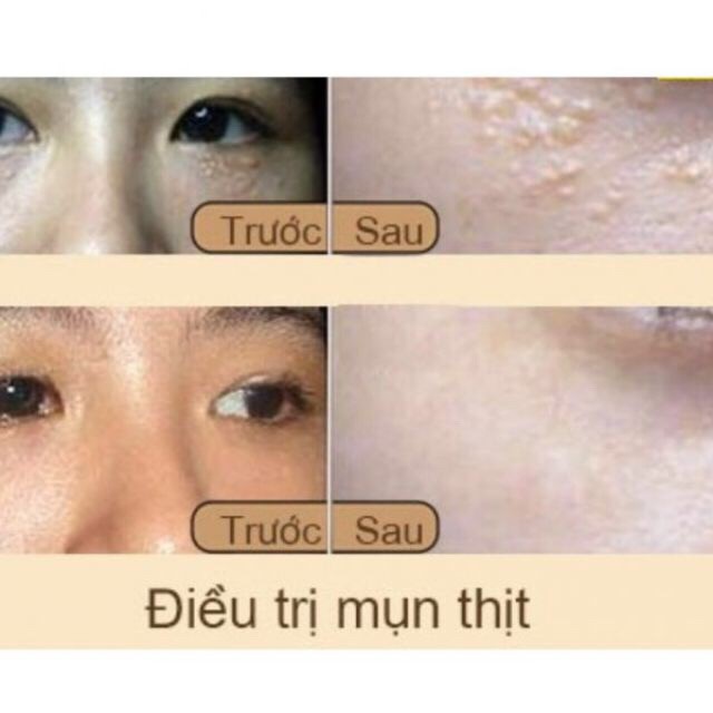 Gel xoá nốt ruồi,mụn thịt,mụn cóc, sẹo lồi Dvelinil Nga