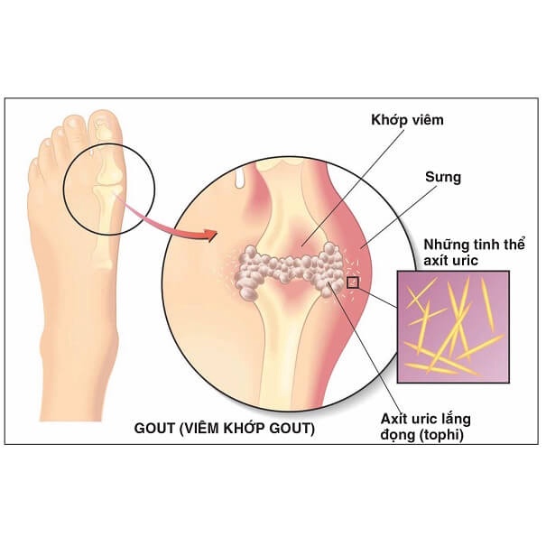 Viên Hỗ Trợ Gout ANSERINE MINAMI