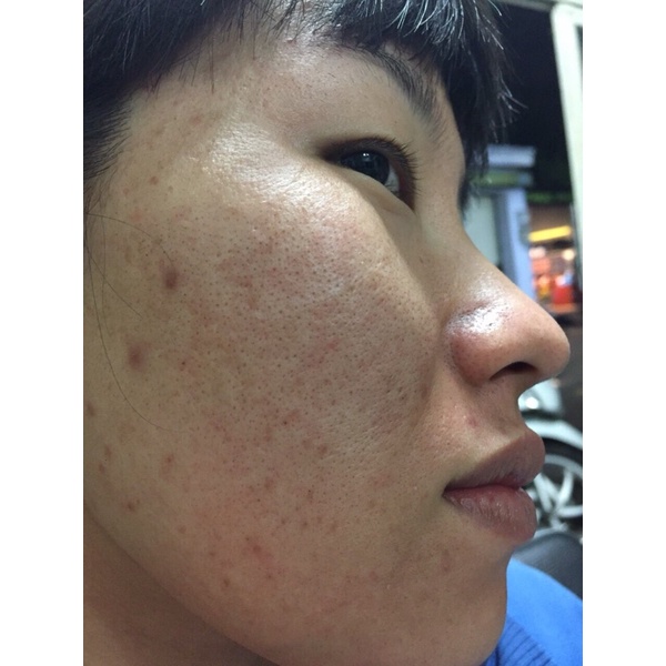 Serum thảo dược mụn may new tái tạo da