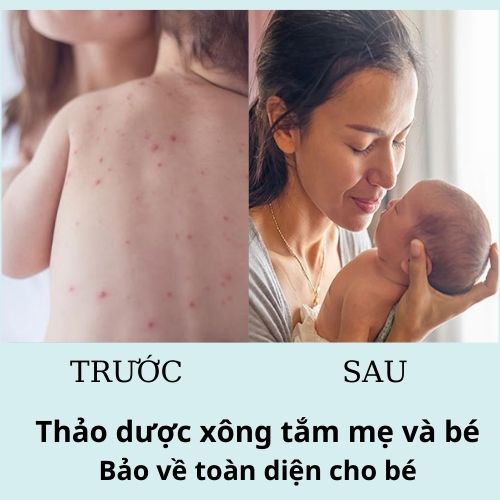 Xông tắm sau sinh cho mẹ và bé_Đông y gia truyền thông cát_hết rôm sảy, mẩn ngứa, viêm da, tắc tia sữa- BÁN SỈ