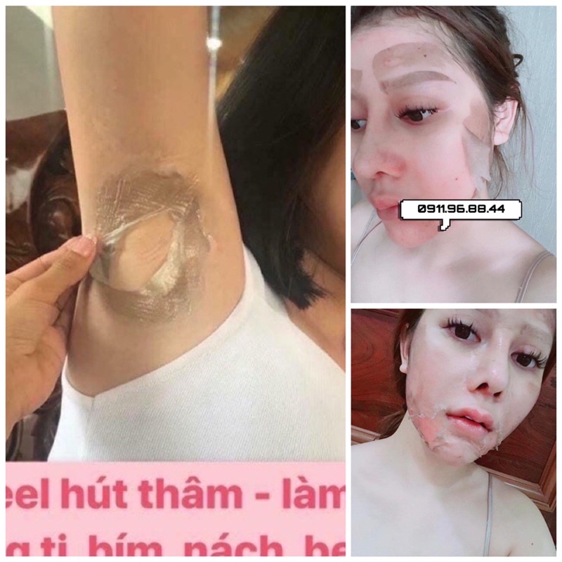 TCA50% 🇺🇸 Phá cắt đáy, lấp đầy sẹo rỗ, sạch thâm mụn, nám tàn nhan, da không đều mầu, làm Hồng ti, peel nách, Mông bẹn..