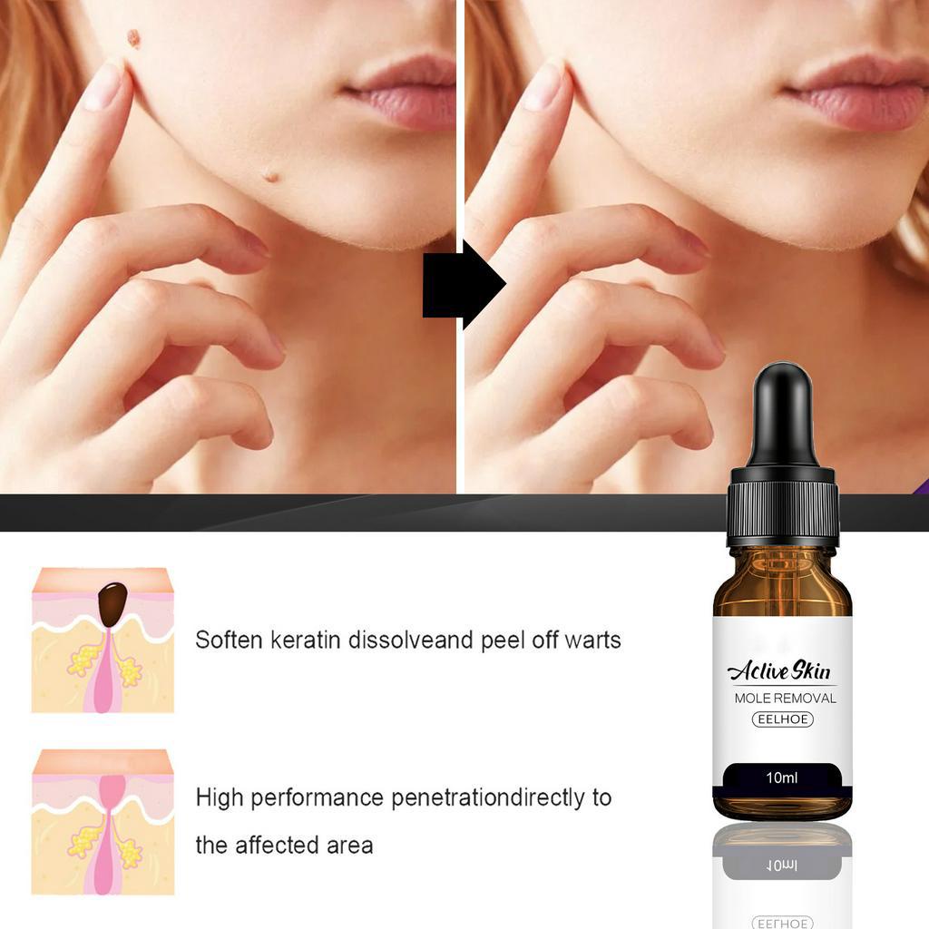 (Xài là hết) ACLIVE SKIN serum tẩy nốt ruồi hiệu quả rõ rệt đối với mụn thịt, mụn cóc, nốt ruồi, tàn nhang v.v...