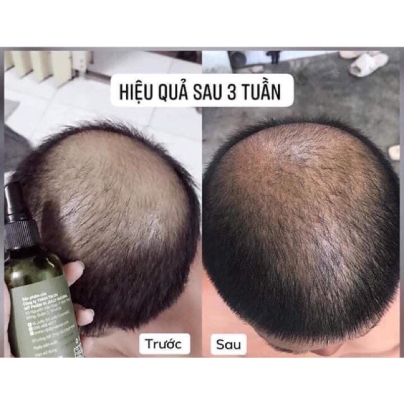 Xịt bưởi mọc tóc Vijuly mẫu mới 150ml-Tinh dầu xịt bưởi Vijully kích mọc tóc