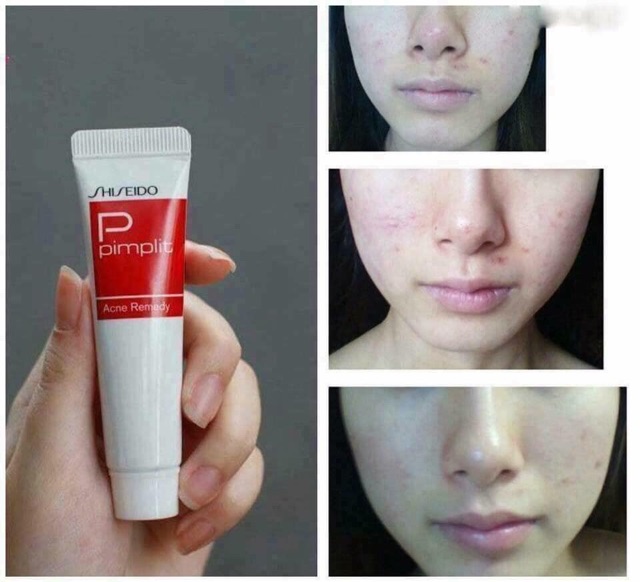 Kem mụn Pimplit của Shiseido Nhật Bản giúp giảm sạch mụn