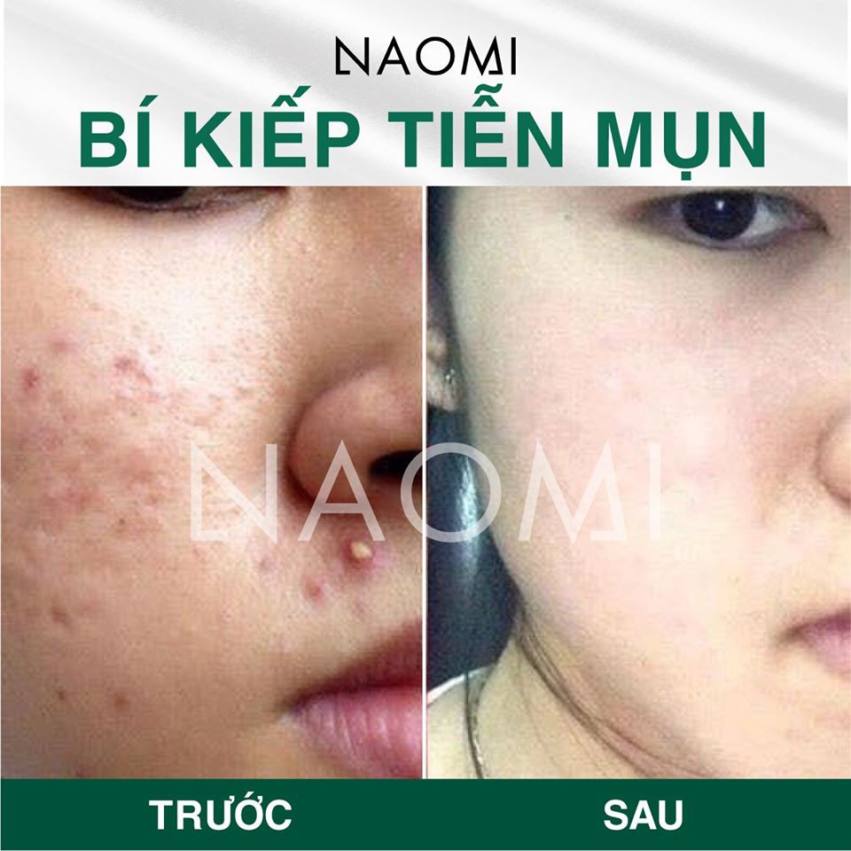 Combo trị mụn naomi | BigBuy360 - bigbuy360.vn