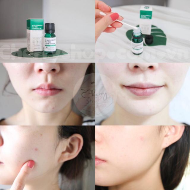 💥🍒Tinh Dầu Tràm Trà "Thần Kỳ" Some By Mi 30 Days Miracle Tea tree Clear spot oil