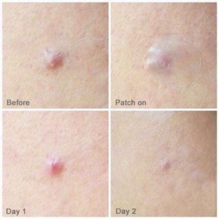 MIẾNG DÁN MỤN COSRX HÀN QUỐC
