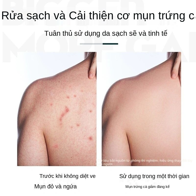 Sữa tắm loại bỏ mụn lưng tẩy tế bào chết trắng da/dầu gội giảm gàu Mancodes lưu hương lâu