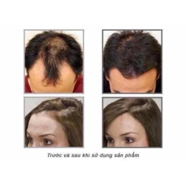 Thuốc ngăn rụng, kích mọc tóc siêu mạnh Higher Strength Kaminomoto Nhật Bản 200ml | BigBuy360 - bigbuy360.vn