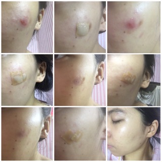 Miếng dán hút mụn Duoderm Extra Thin ( Duo derm extra thin ) - Chính hãng