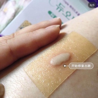 Miếng dán mụn DUODERM