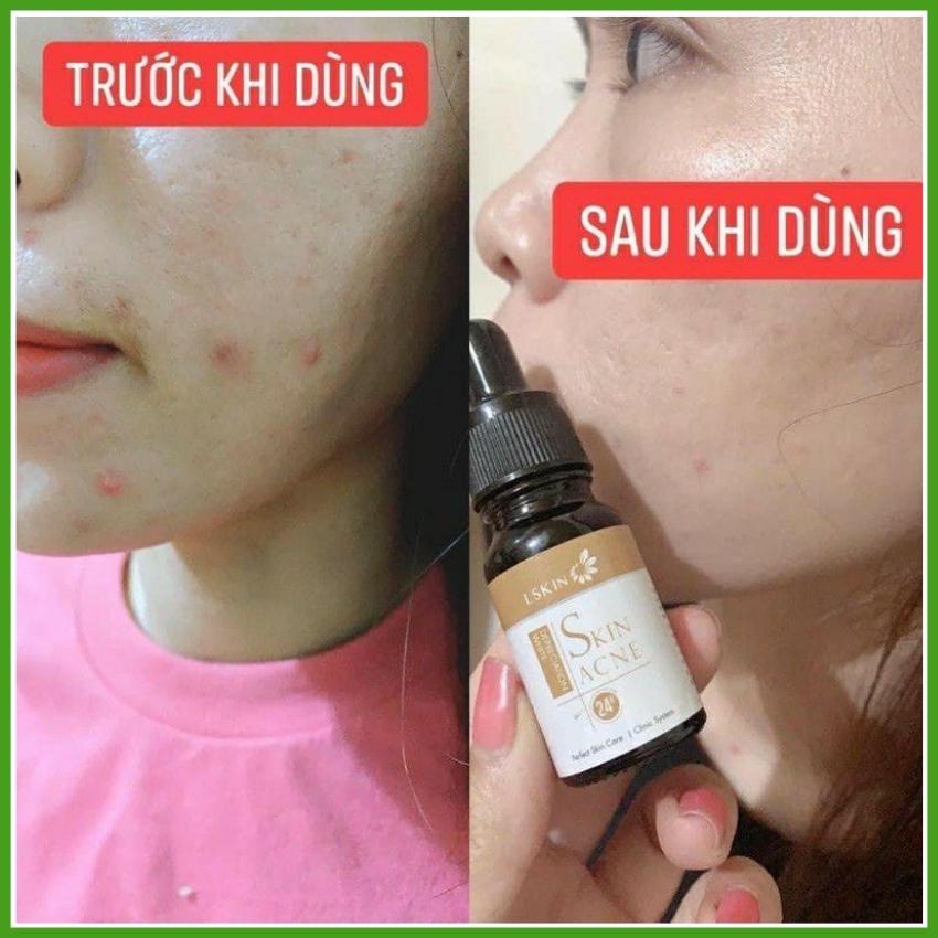 [Cốt Mụn } Cốt Mụn Bạch Sen Lskin Đan Thy GROUP