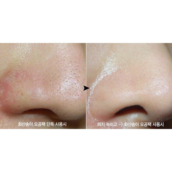 [P'BEAUTY] Nước diệt khuẩn mụn cám – ACNE SPOT CONTROL