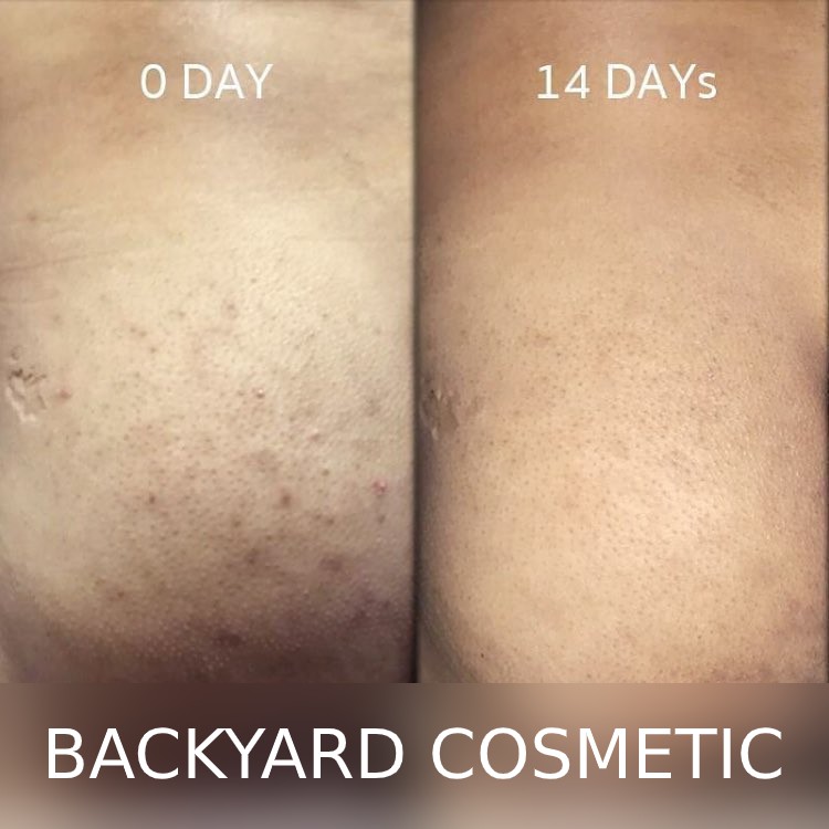 Tinh chất Serum Gíup Giảm Mụn, Mờ Thâm Mông, Trắng Da Và Hỗ Trợ Điều Trị Rạn- Backyard Cosmetic 10%Niacinamide - 30ml | BigBuy360 - bigbuy360.vn