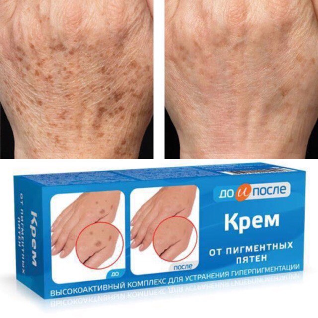 Kem Trị Đồi Mồi Da Tay Kpem, Kem Trị Đồi Mồi Đốm Nâu Hàng Nga (50ml)