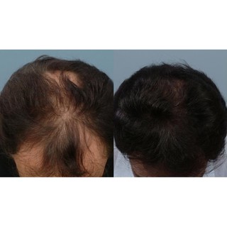 Minoxidil - Dung dịch hỗ trợ mọc tóc cho nam