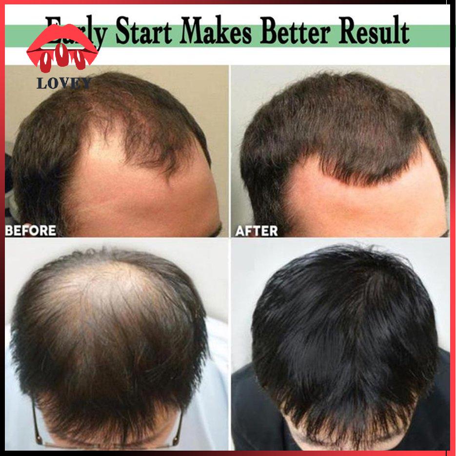 [Hàng mới về] Thanh Lăn Cọng Kim Titan Kích Thích Mọc Râu Và Chống Rụng Tóc