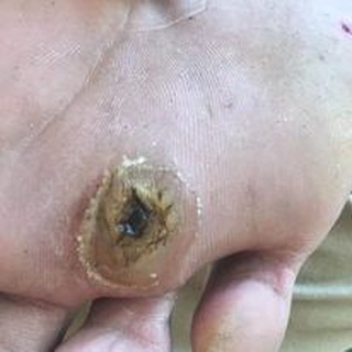 TẨY BONG MỤN CÓC NGA