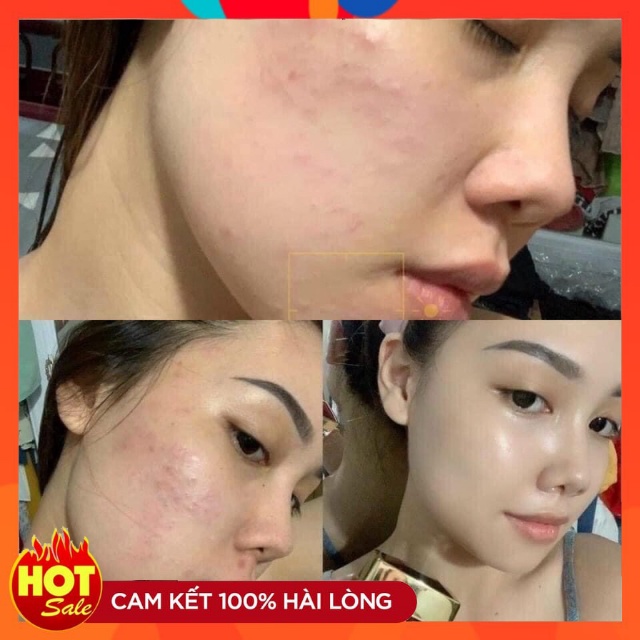 Cao mụn sâm đỏ 36 vị Meea Oranic hàng công ty | BigBuy360 - bigbuy360.vn