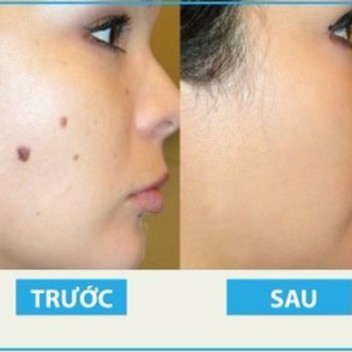 Gel tẩy nốt ruồi Dvelinil cam kết tẩy nốt ruồi, mụn cóc, mụn thịt, sẹo lồi gây hại cho da [𝐓𝐚̣̆𝐧𝐠 𝐦𝐚́𝐲 𝐦𝐚𝐬𝐬𝐚𝐠𝐞 𝐦𝐚̣̆𝐭]