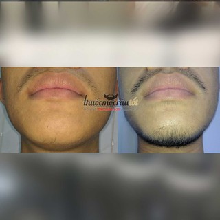 Thuốc mọc râu Minoxidil 5% dạng bọt