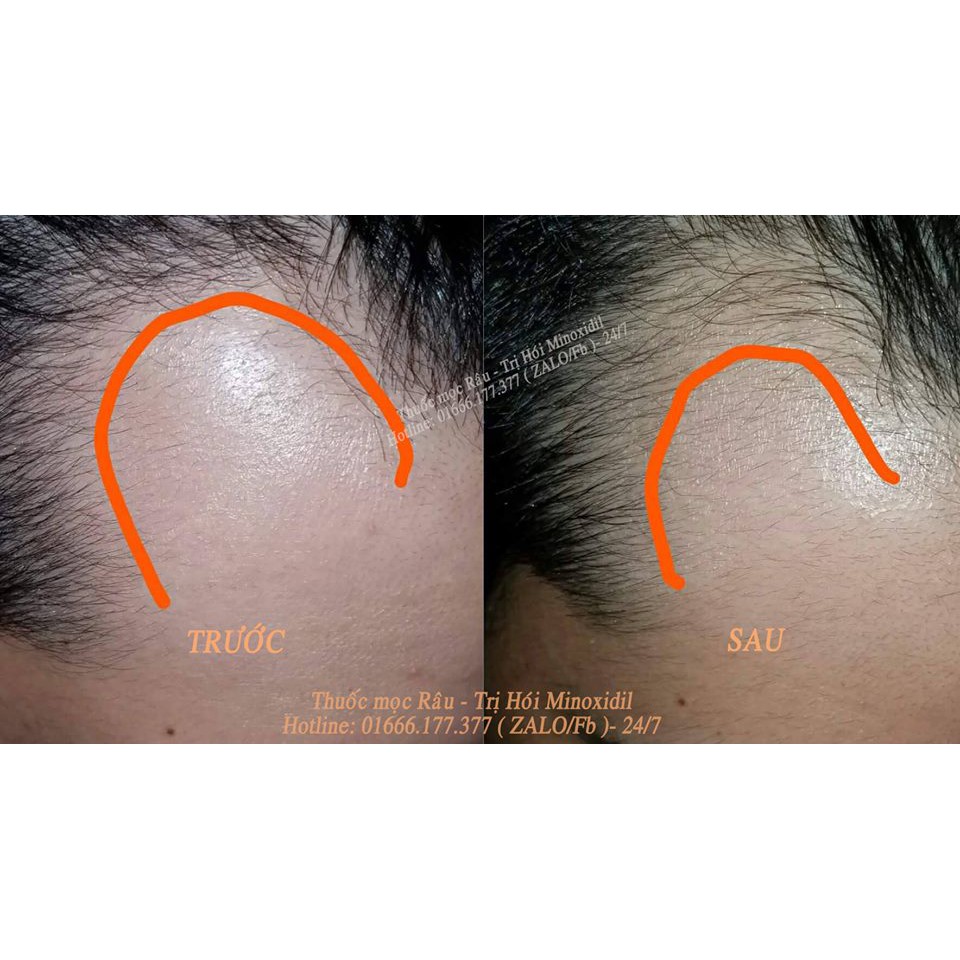 Thuốc Mọc Râu - Trị Hói Minoxidil 5% Kirkland chính hãng - Tiết kiệm hơn với Hộp lớn dùng trong 6 Tháng