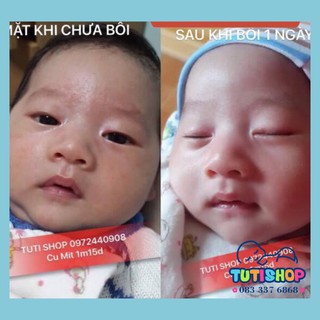 KEM BÔI CHÀM SỮA CỰC TỐT