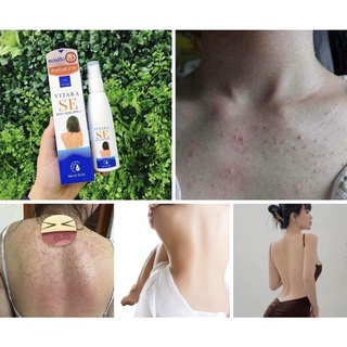 [Hàng Thái Bao Check] Xịt mụn toàn thân Thái Lan Vitara SE BODY ACNE SPRAY giảm thâm mụn, sẹo mụn 50ml