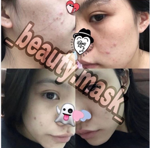 Mặt nạ Wis+ ( có ảnh thật của khách sau khi dùng) | Thế Giới Skin Care