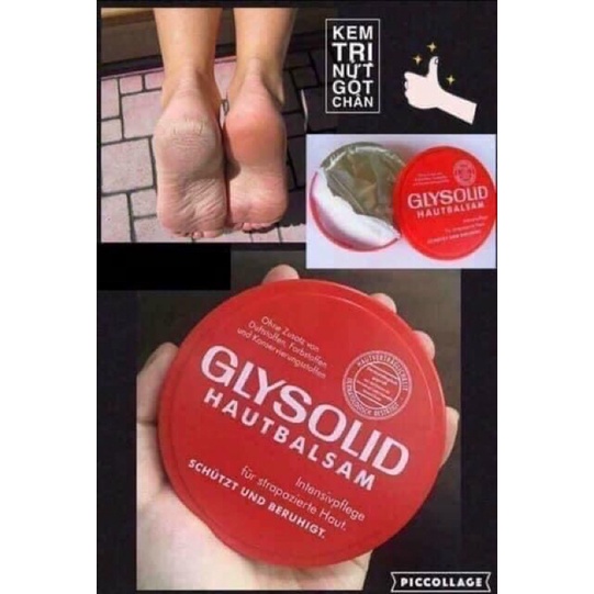 Kem dưỡng glysolid chăm sóc cho gót chân bị nứt nẻ, vẩy nến, á sừng