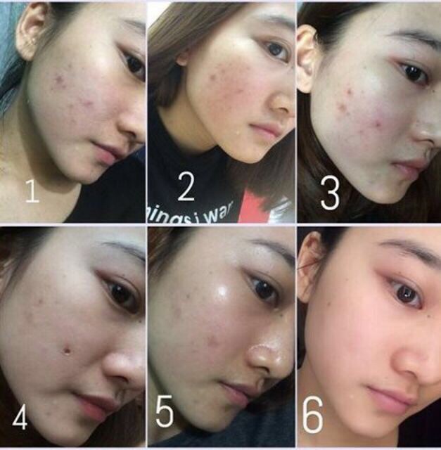 Kem mụn Pimplit của Shiseido Nhật Bản giúp giảm sạch mụn