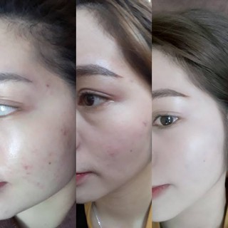 Tinh chất Dermafirm - Kiểm soát Dầu Mụn - Purifying Essence
