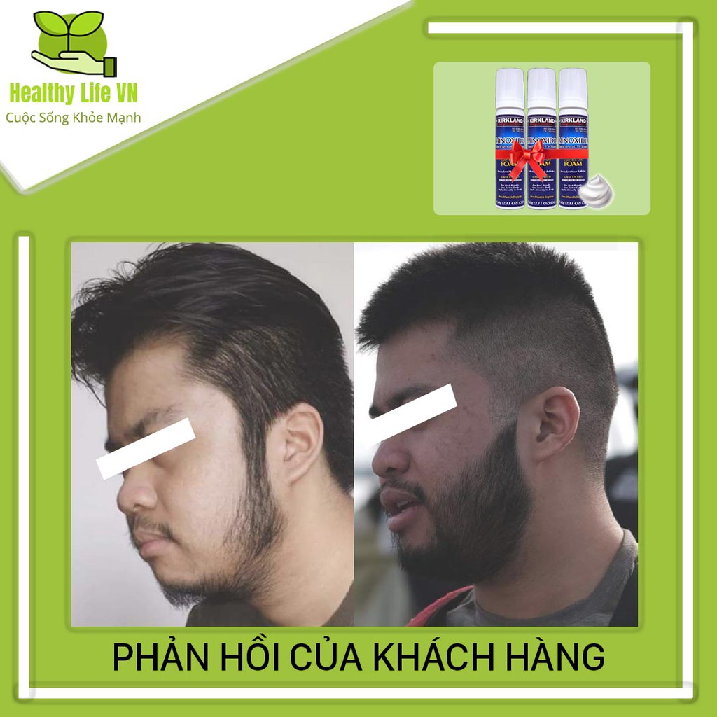 Minoxidil 5% Dạng Bọt Mọc Râu Tóc Kirkland Mỹ Combo 3 Lọ